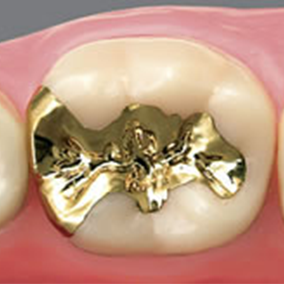 ゴールドインレー