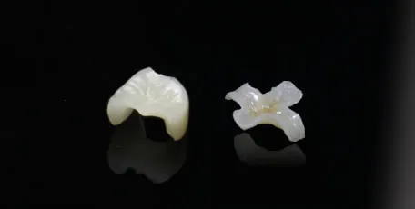 プレスセラミックインレー