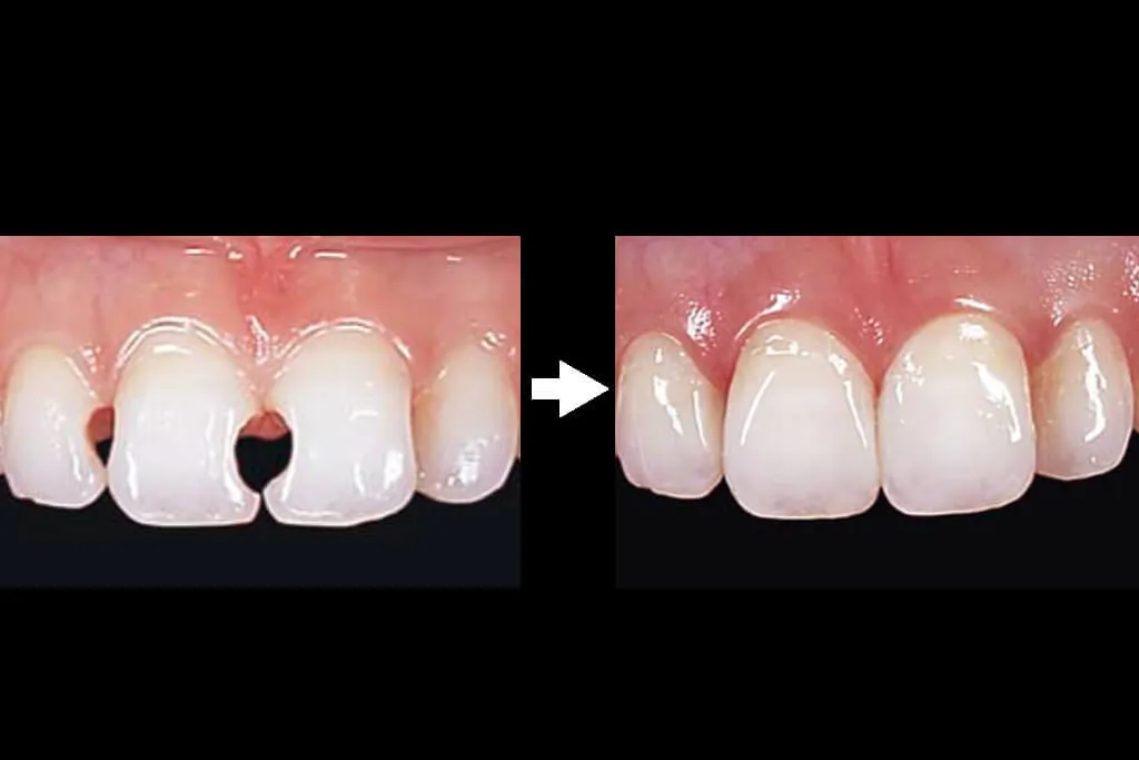 グラディアダイレクト