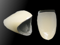 メタルボンド<br>(パラジウム系)