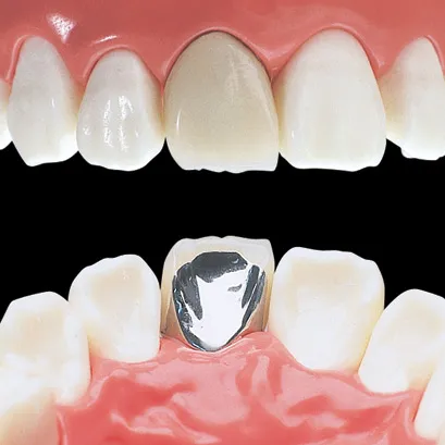 硬質レジン前装冠