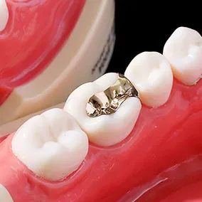 ゴールドメタル(18K)インレー