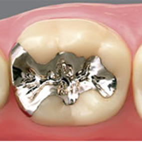 メタルインレー(銀歯)