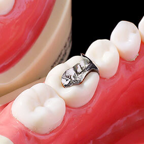 メタルインレー(銀歯)